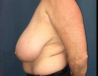 Breast Reduction Before & After Patient #1771