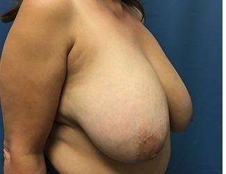 Breast Reduction Before & After Patient #1782