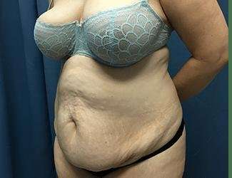 Tummy Tuck Before & After Patient #380