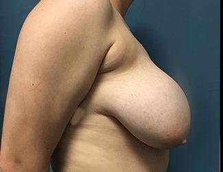 Breast Reduction Before & After Patient #1793