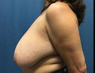 Breast Reduction Before & After Patient #1804