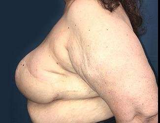 Breast Reduction Before & After Patient #1815