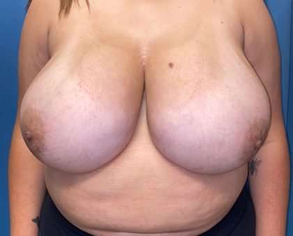 Breast Reduction Before & After Patient #1829