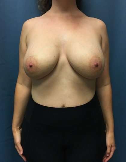 Breast Reduction Before & After Patient #1843