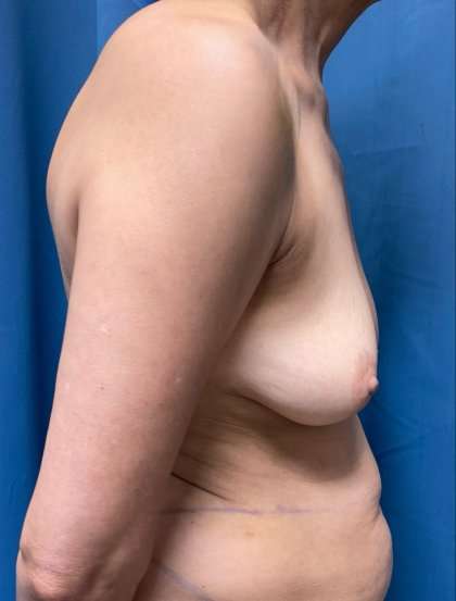 Breast Lift Before & After Patient #1861