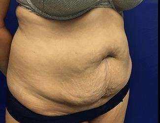Tummy Tuck Before & After Patient #395
