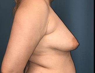 Breast Lift Before & After Patient #1903