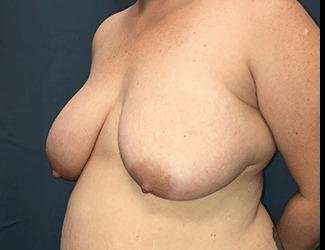 Breast Lift Before & After Patient #1934