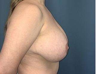 Breast Lift Before & After Patient #1945