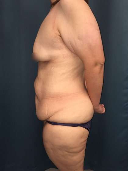 Tummy Tuck Before & After Patient #406