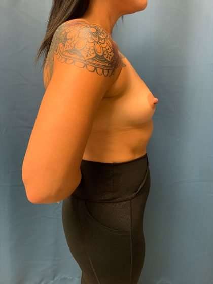Breast Augmentation Before & After Patient #2049