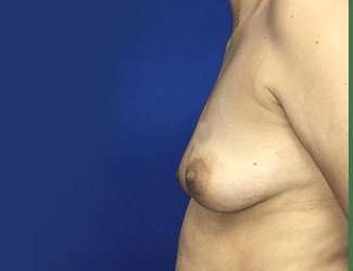 Breast Augmentation Before & After Patient #2069