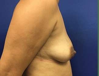Breast Augmentation Before & After Patient #2080