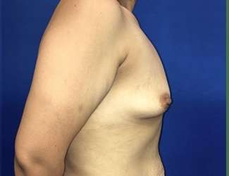 Breast Augmentation Before & After Patient #2091