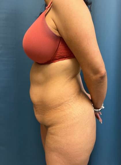 Tummy Tuck Before & After Patient #417