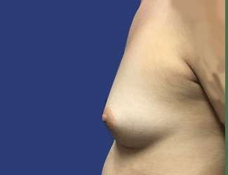 Breast Augmentation Before & After Patient #2102