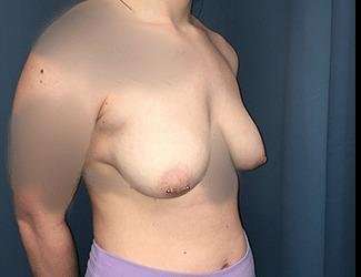Breast Augmentation Before & After Patient #2111