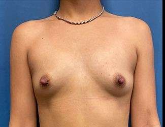 Breast Augmentation Before & After Patient #2169
