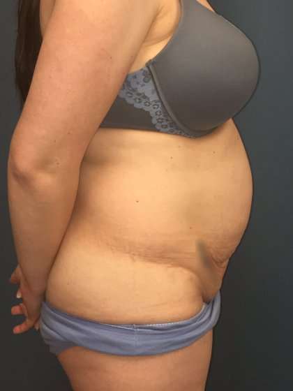 Tummy Tuck Before & After Patient #428