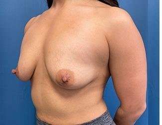Breast Augmentation Before & After Patient #2213