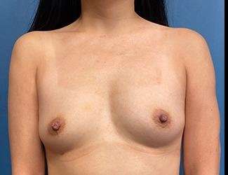 Breast Augmentation Before & After Patient #2220