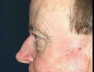 Blepharoplasty Before & After Patient #2251
