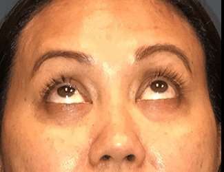 Blepharoplasty Before & After Patient #2260