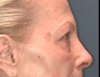 Blepharoplasty Before & After Patient #2271