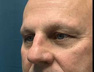 Blepharoplasty Before & After Patient #2282