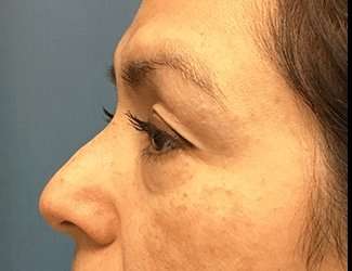 Blepharoplasty Before & After Patient #2293