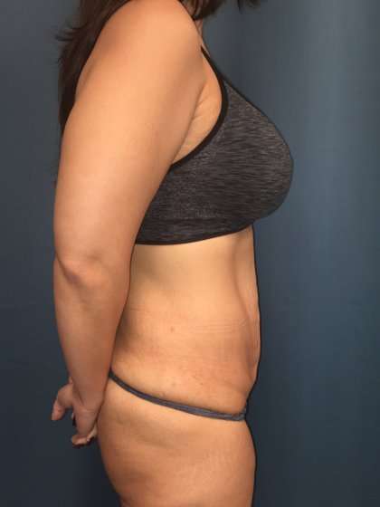 Tummy Tuck Before & After Patient #439