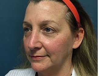 Blepharoplasty Before & After Patient #2308