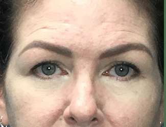 Blepharoplasty Before & After Patient #2315