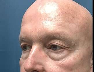 Blepharoplasty Before & After Patient #2328