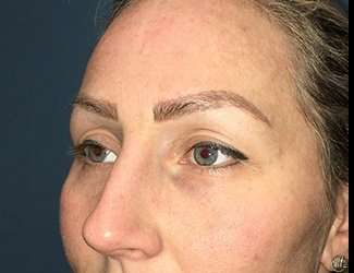 Blepharoplasty Before & After Patient #2339