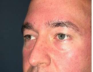 Blepharoplasty Before & After Patient #2352
