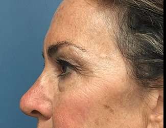 Blepharoplasty Before & After Patient #2368