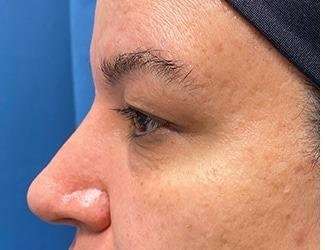 Blepharoplasty Before & After Patient #2385