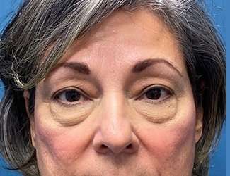 Blepharoplasty Before & After Patient #2397