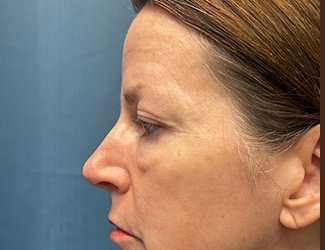 Blepharoplasty Before & After Patient #2408