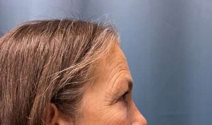 Blepharoplasty Before & After Patient #2419