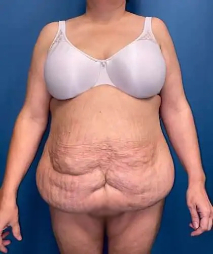 Tummy Tuck Before & After Patient #446