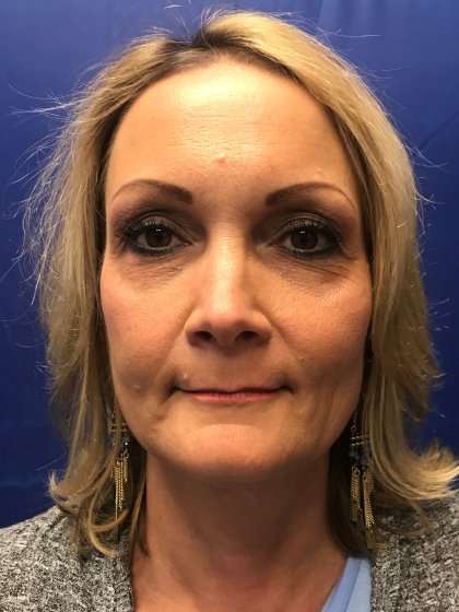 Blepharoplasty Before & After Patient #2437