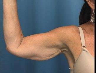 Arm Lift Before & After Patient #2461