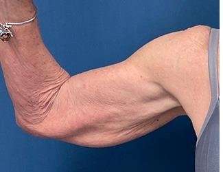 Arm Lift Before & After Patient #2473