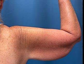 Arm Lift Before & After Patient #2482