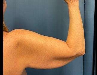 Arm Lift Before & After Patient #2491
