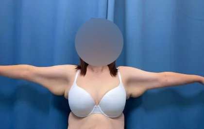 Arm Lift Before & After Patient #2498