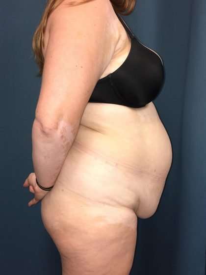 Tummy Tuck Before & After Patient #271