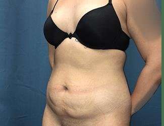 Tummy Tuck Before & After Patient #457